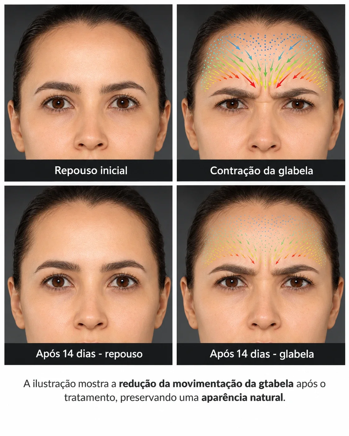 Comparação ilustrativa da contração da glabela antes e 14 dias após aplicação de toxina botulínica, mostrando redução da movimentação muscular